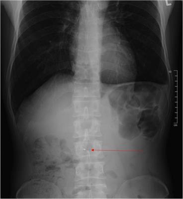 Retained stone retrieval basket causing chronic pancreatitis: a case report
